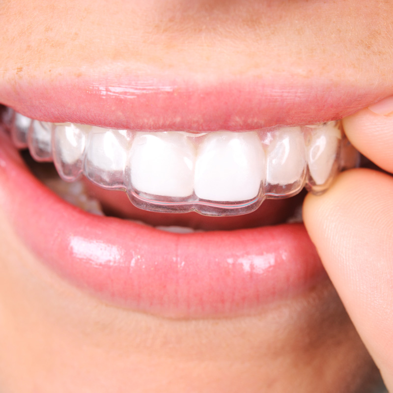 lady with invisalign